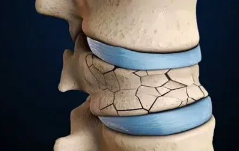 Spine Knowledge Lecture 3: How much do you know about PVP vertebroplasty?