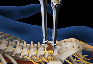 Lumbar posterior interbody fusion technology training camp: Perlove integrated mobile C-shaped arm to help the operation