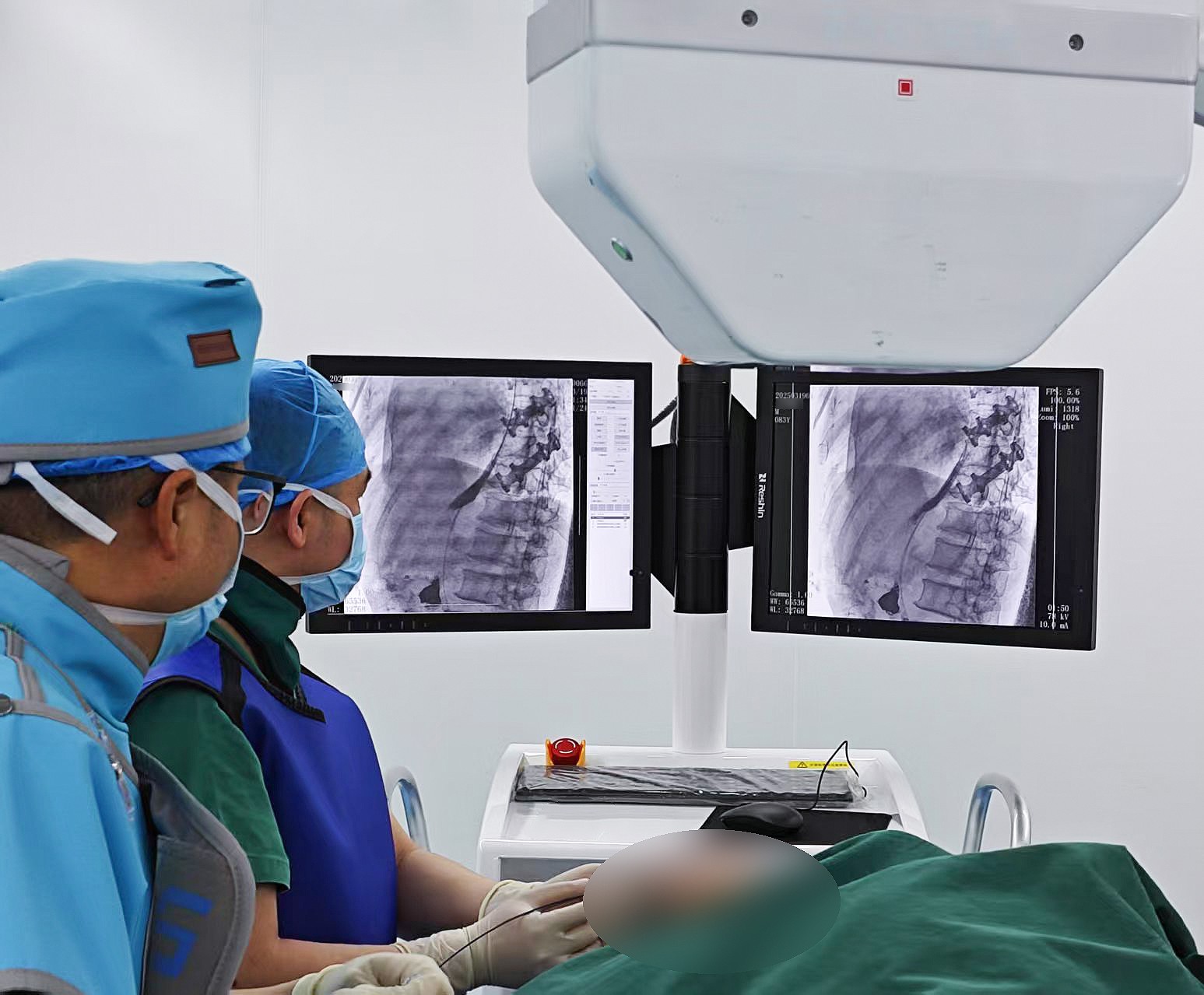 Application of Interventional C-arm in Esophageal Stricture Stent Placement